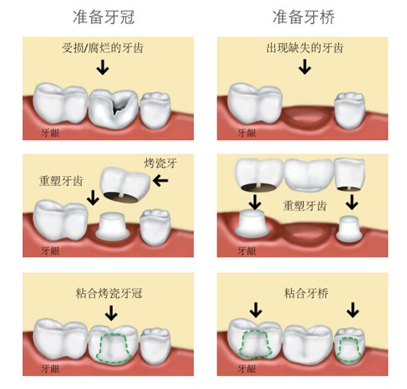 烤瓷牙怎么做,烤瓷牙你真的了解吗?