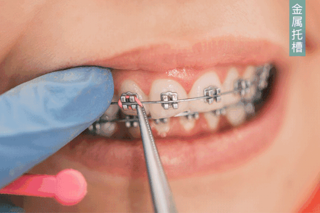 牙齿正畸中心    东莞成年人牙齿矫正价格多少钱,需要结合以下因素